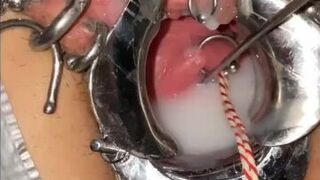 Extreme cervix sounding - porn video